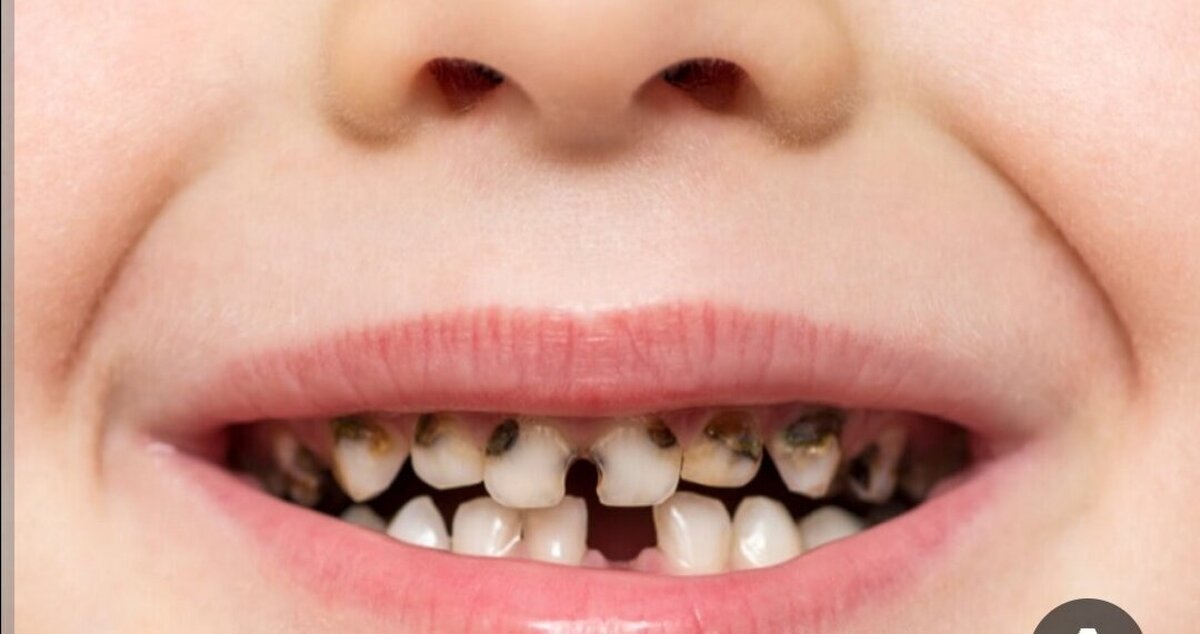 خرابی دندان نشانه این بیماری است