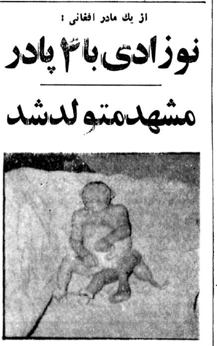 عکس/ تولد نوزاد ۴ پای افغان در مشهد