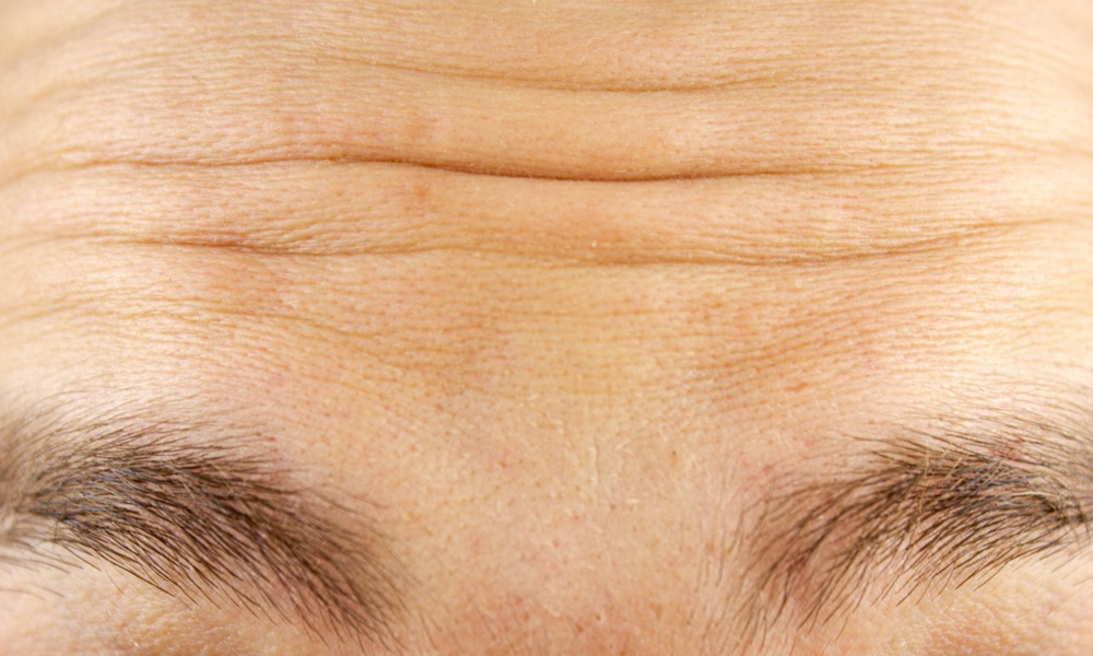 رفع چین و چروک رفع چین و چروک