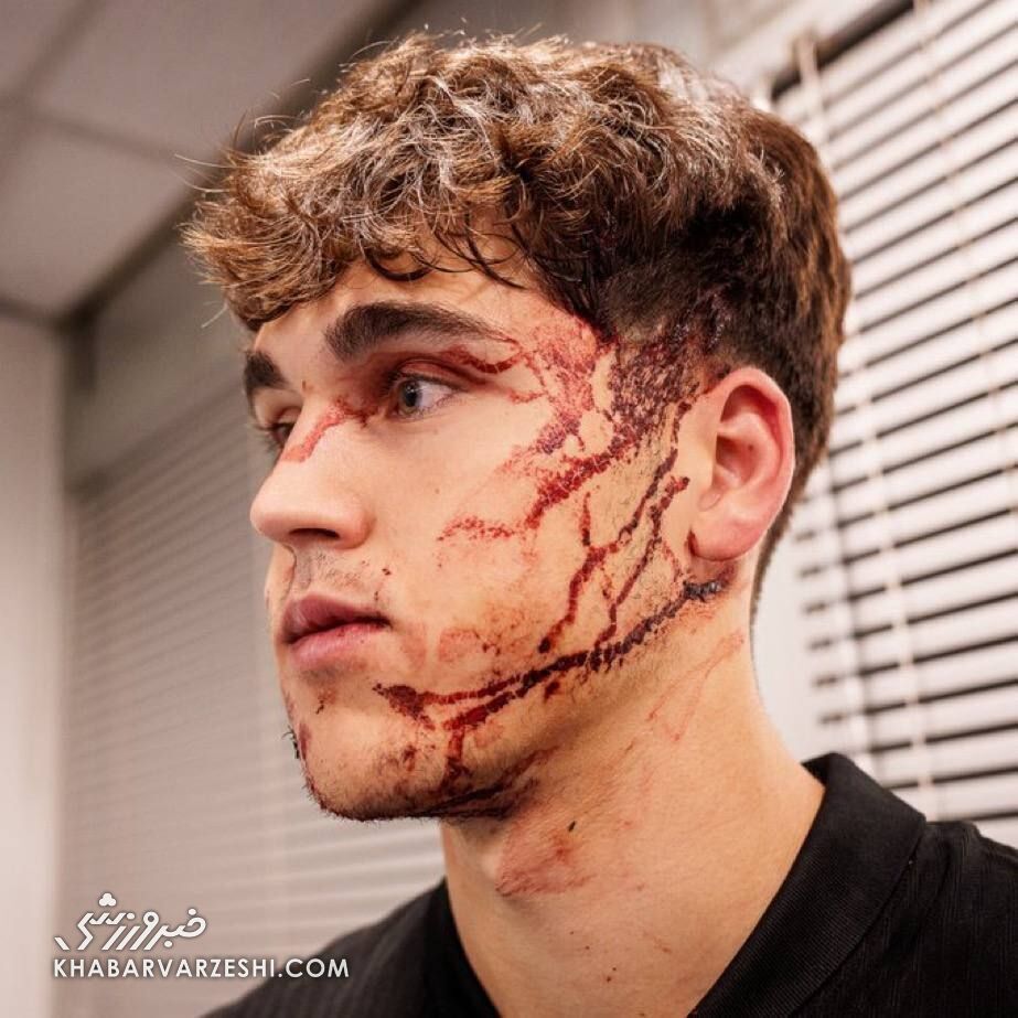 عکس/ مصدومیت وحشتناک مدافع بارسلونا در بلگراد؛ صورت زخمی ۲! +ویدیو