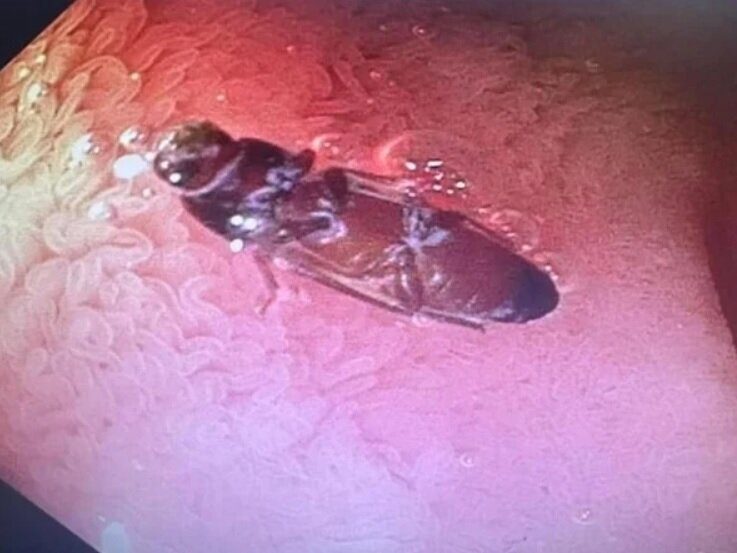 عکس/ یک سوسک زنده در روده مرد بدشانس