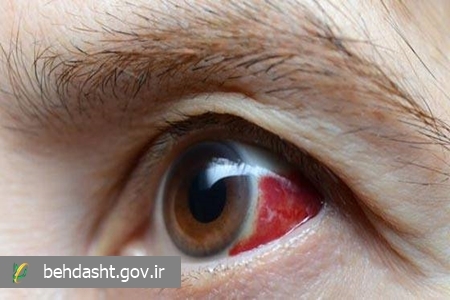 پیشگیری از سکته چشمی با کنترل برخی ریسک فاکتور‌ها