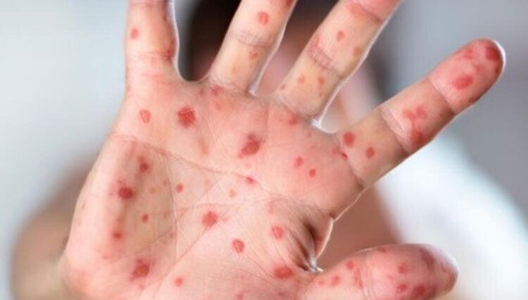 زنگ خطر شیوع سرخک در یزد به صدا درآمد