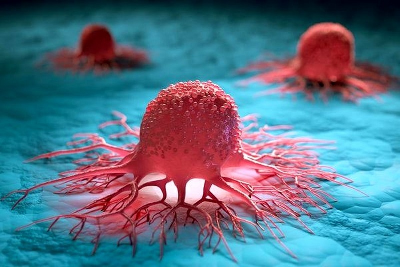 سرطان روده؛ بیماری خاموشی که با تشخیص زودهنگام قابل کنترل است