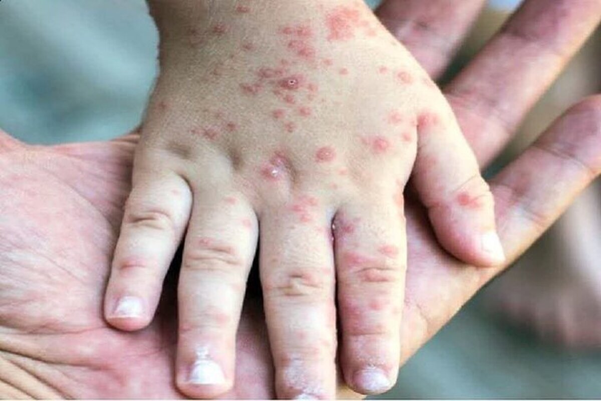 سرخک به ایران برگشت/ مراقب این علائم باشید