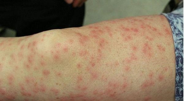 674 مبتلا به سرخک؛ شیوع در کشور‌های همسایه