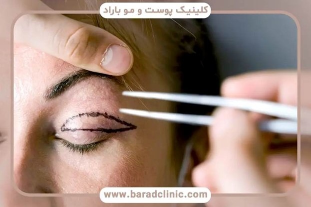 بهترین دکتر بلفاروپلاستی را چگونه انتخاب کنیم؟