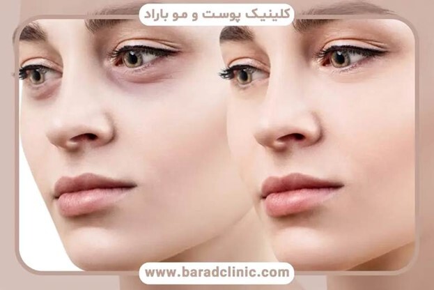 نمونه کار بلفاروپلاستی