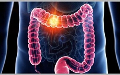 چرایی بروز سرطان روده بزرگ و علائم ابتلا به آن