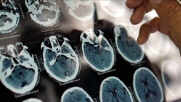 ارتباط عجیب میان چاقی و پیشرفت این بیماری ترسناک کشف شد