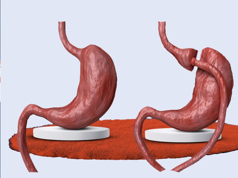 عمل اسلیو معده یا عمل بای پس معده؛ کدام روش کاهش وزن موثرتر است؟