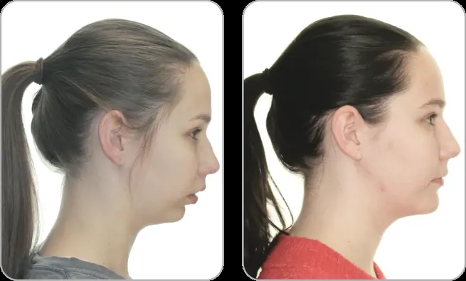 درمان عقب بودن فک پایین در بزرگسالان