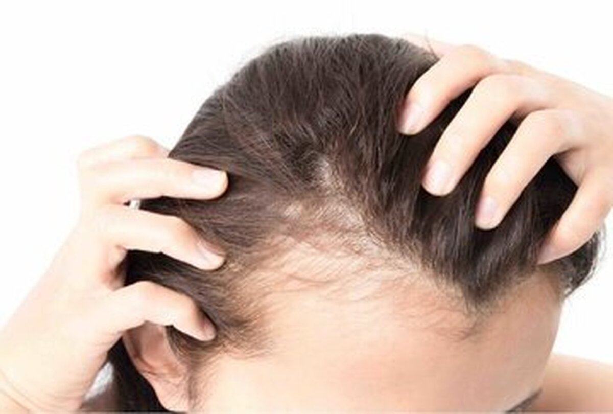 بهترین روش‌ها برای جلوگیری از ریزش مو