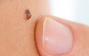 این علامت می‌گوید خال روی پوست شما سرطانی است