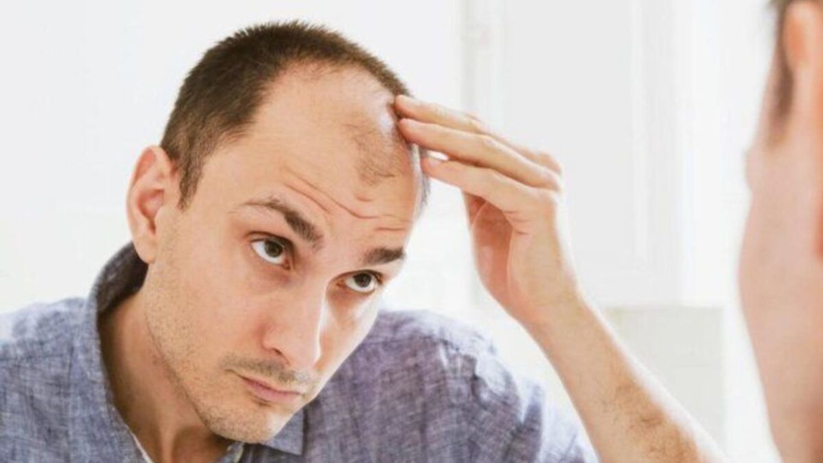 چند باور نادرست درباره ریزش مو