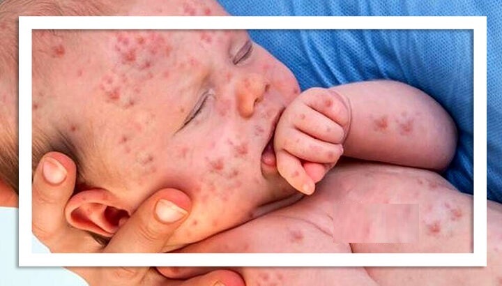 جولان دوباره سرخک