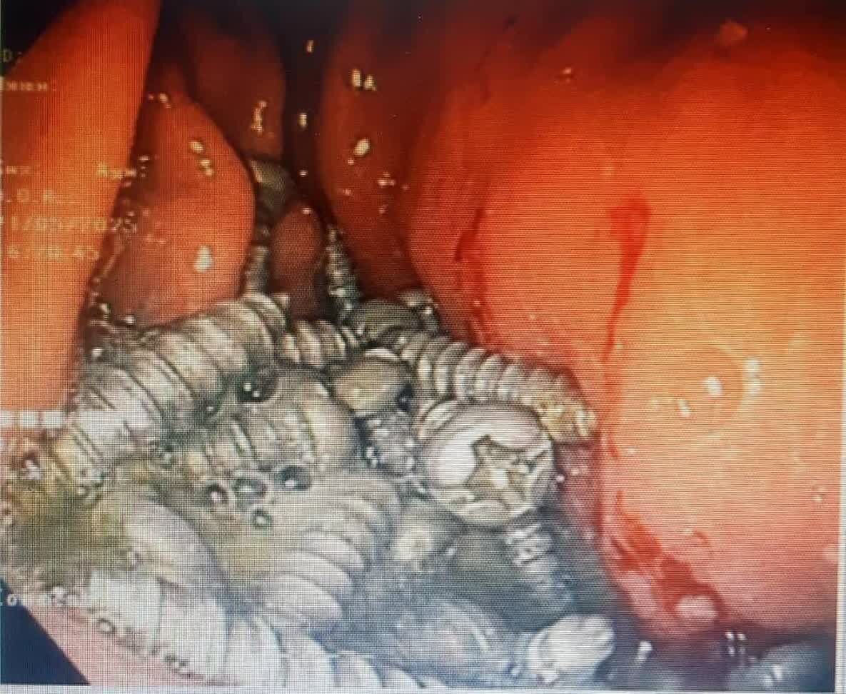 خارج کردن 47 پیچ فلزی از معده یک بیمار در کرج