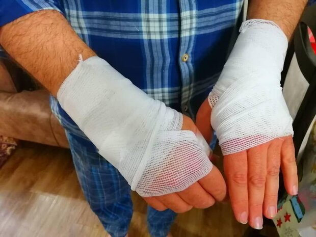 شایع‌ترین علت سوختگی در ایران بر اثر چیست؟