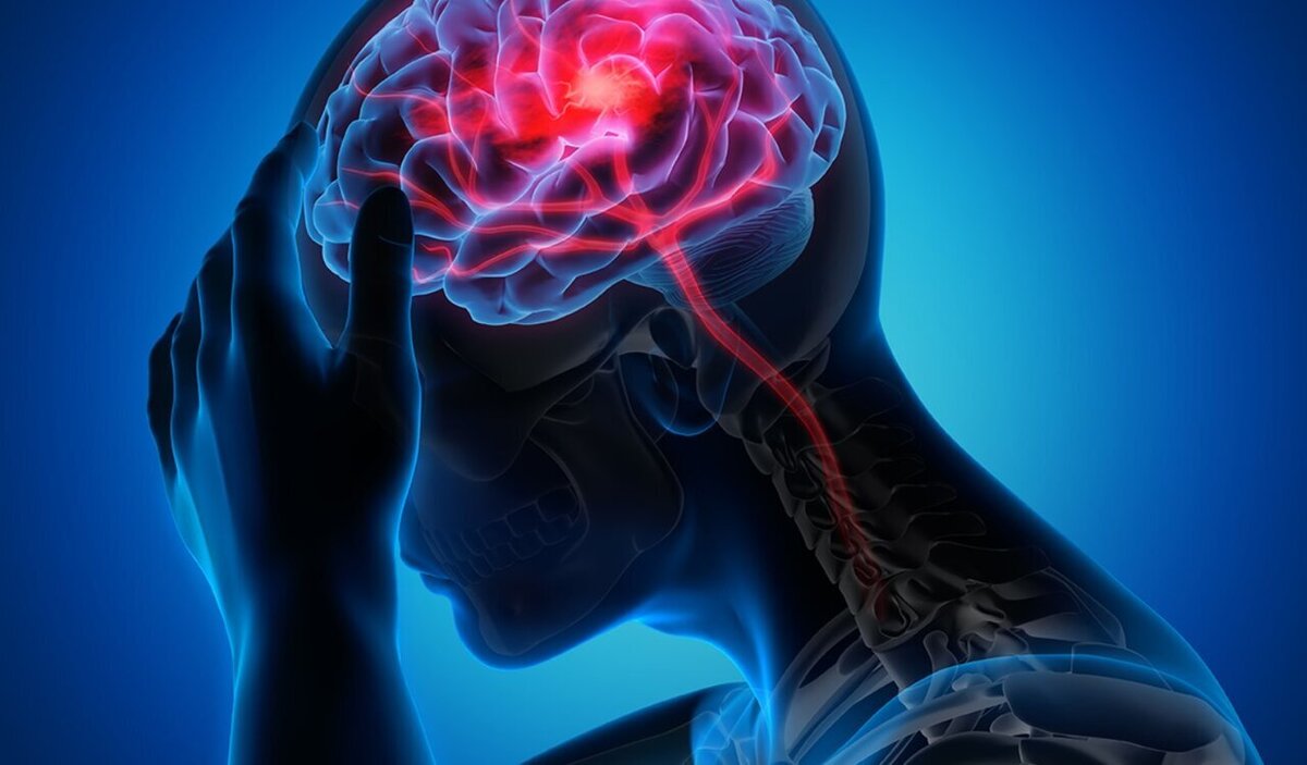 احساس خستگی مداوم دارید؟ احتمال سکته مغزی وجود دارد