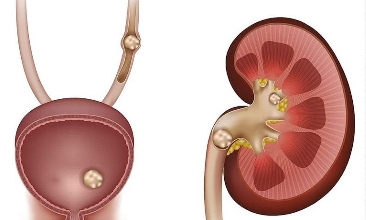 اگر سنگ کلیه دارید این چند توصیه را جدی بگیرید