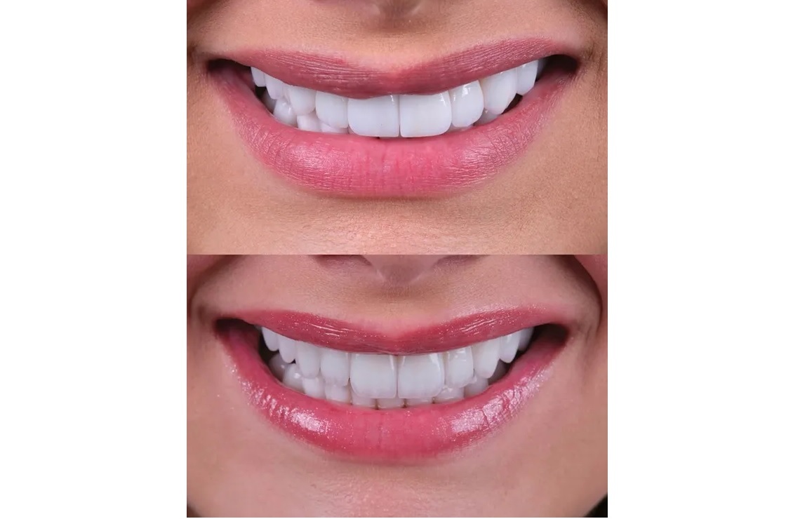 فرق کامپوزیت لبه شیشه‌ای با سایر کامپوزیت‌ها