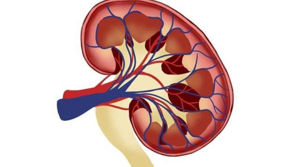 علائم، درمان و باور‌های غلط درباره سنگ کلیه