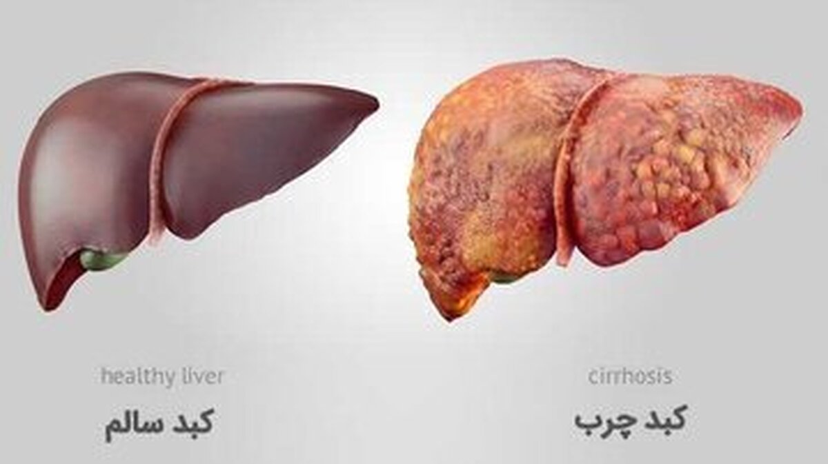ویتامین کبد چیست؟ / ۵ ویتامین برای سلامتی کبد
