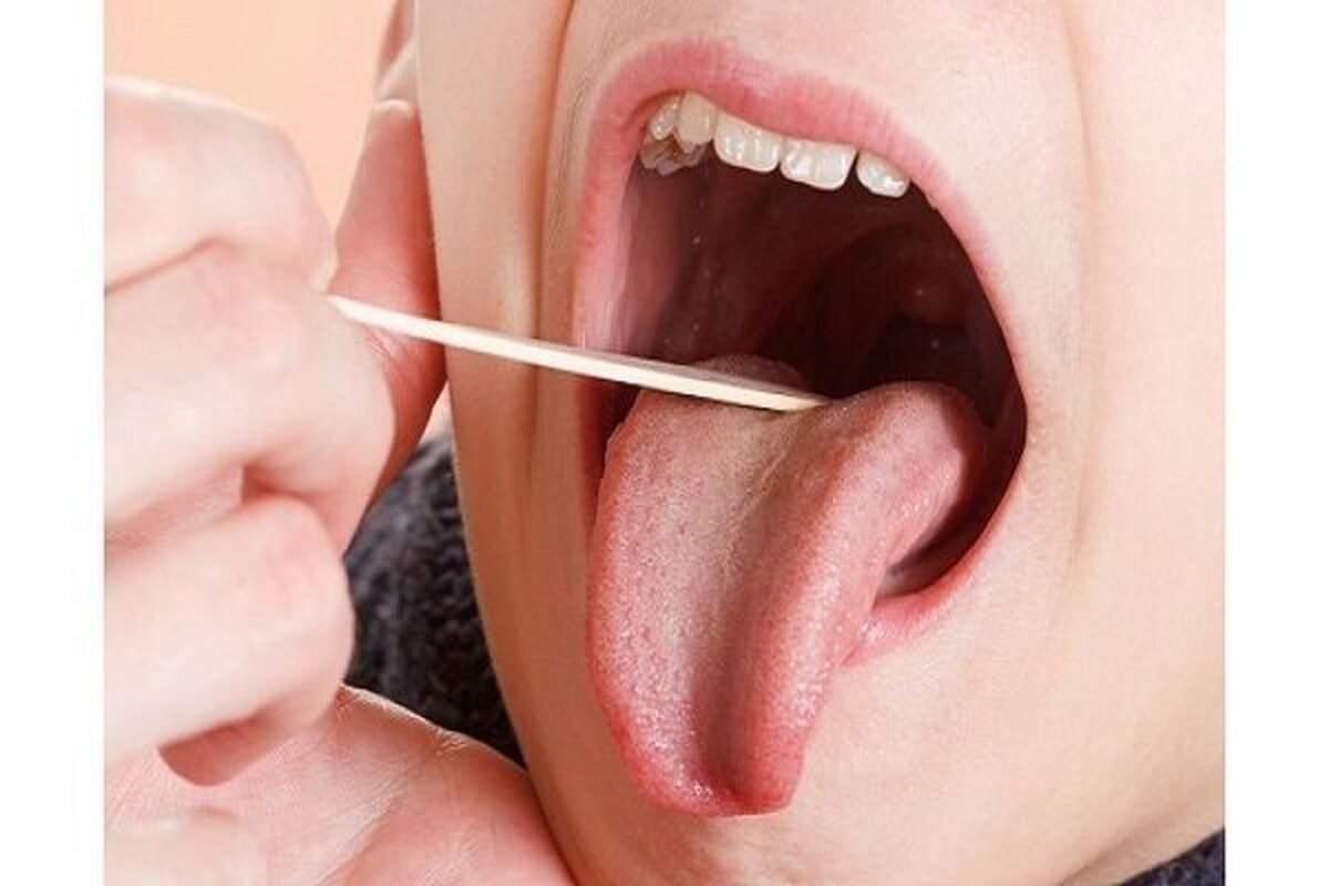 علت اصلی شکاف و ترک روی زبان چیست؟