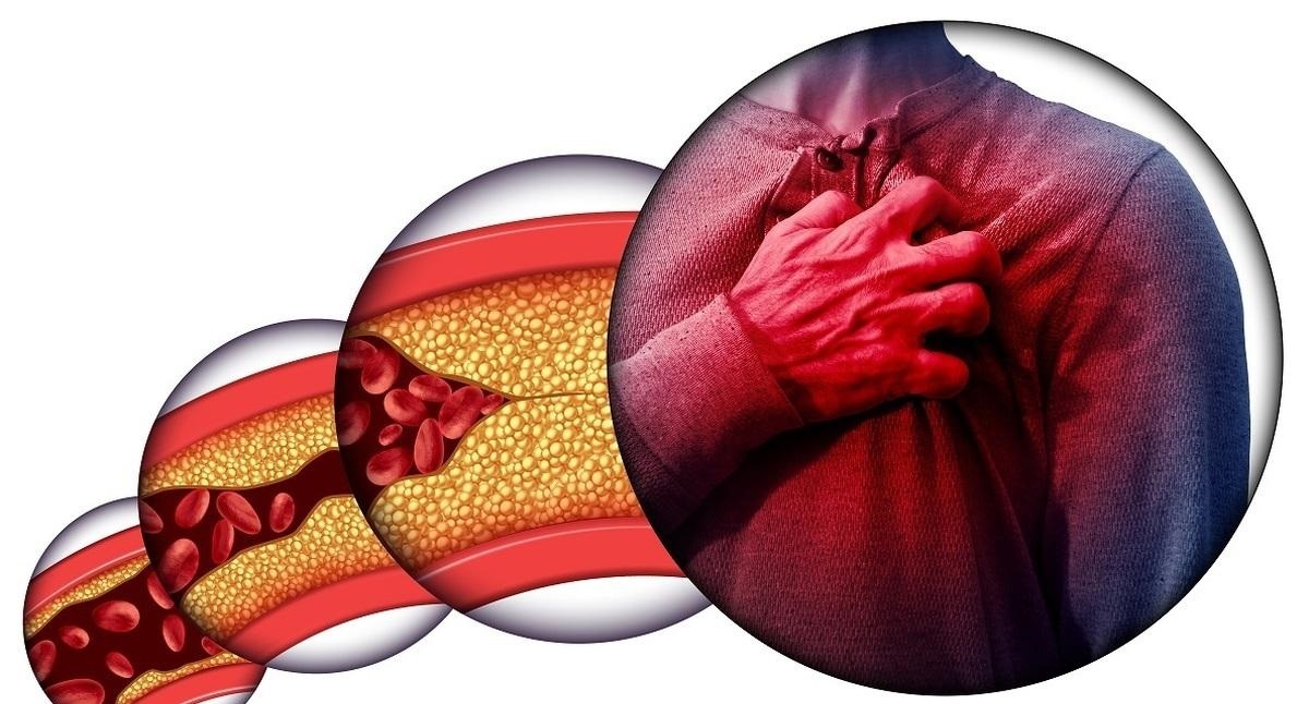 چربی خون بالا/قاتل خاموشی که رگ هایتان را می‌بندد!