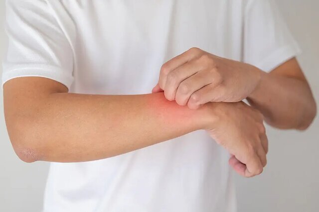 ابزار مؤثر برای کنترل اگزما