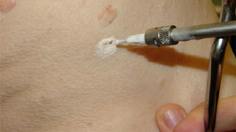 لیزر زگیل تناسلی