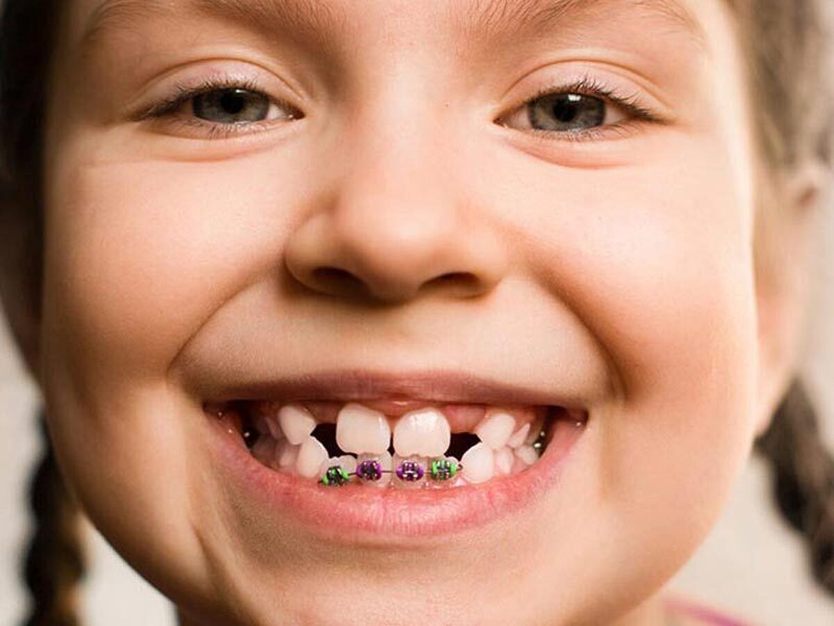 چرا ۷ سالگی بهترین سن برای درمان ارتودنسی است؟