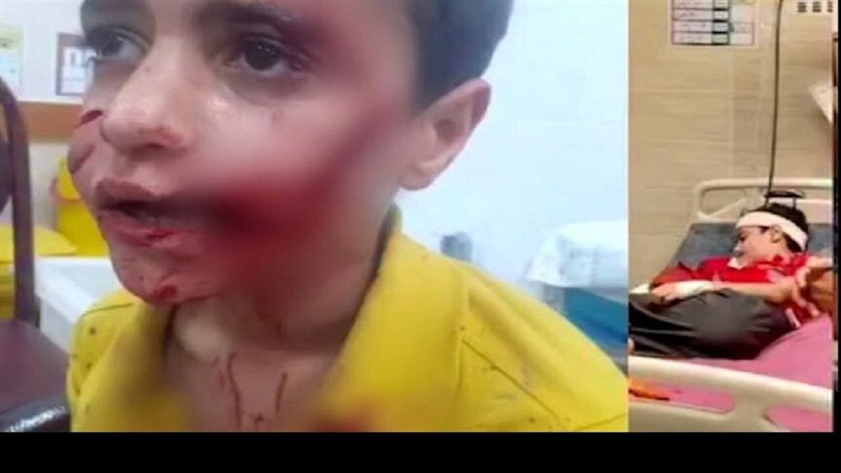 کودک ۱۱ ساله قربانی حمله ‌سگ‌های ولگرد شد