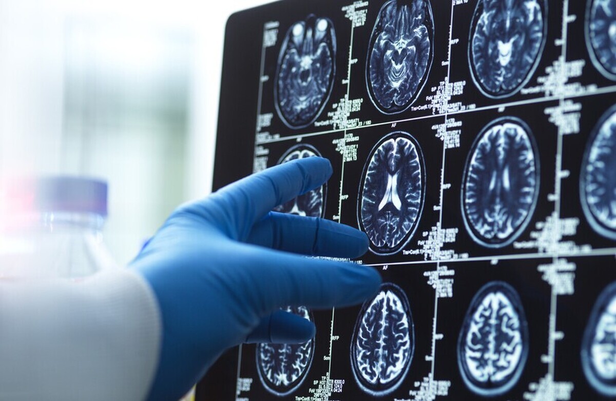 ذخیره‌سازی خاطرات مصنوعی برای بیماران آلزایمر در امارات