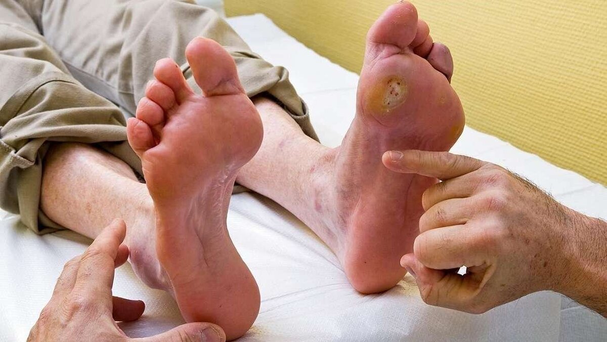 دیابتی‌ها چه کار کنند زخم پای دیابتی نگیرند؟