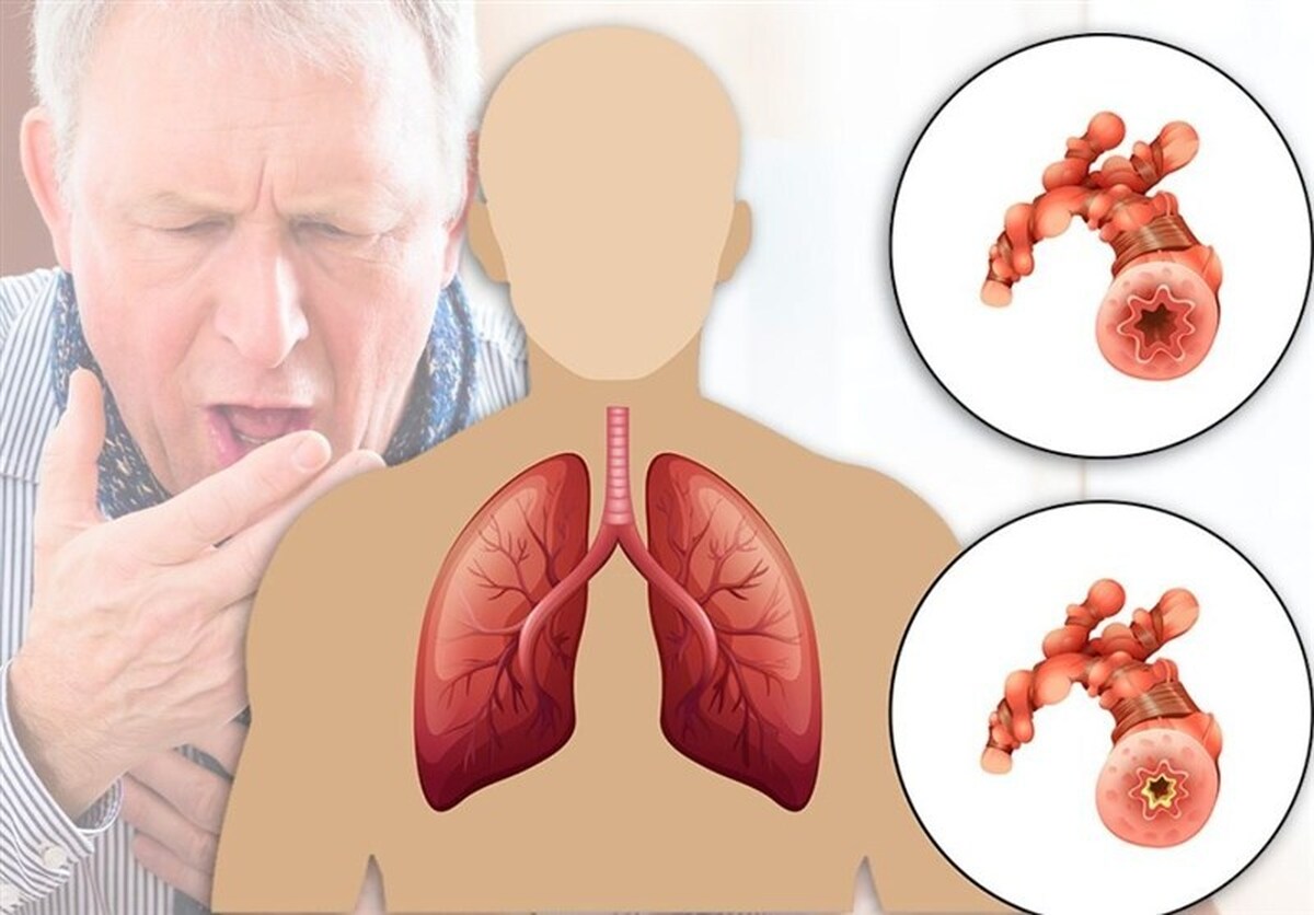 ابتلای ۱۰ میلیون ایرانی به آسم و انسداد ریوی