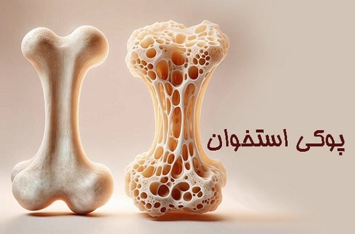 این افراد در خطر پوکی استخوان اند!