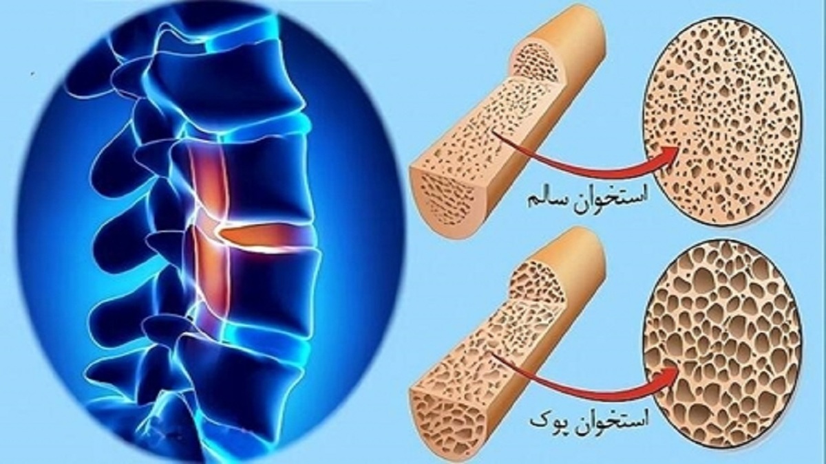 پوکی استخوان از این سن و سال آغاز می‌شود