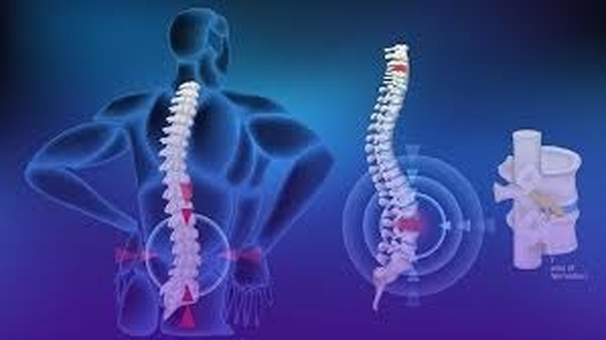 دیسک کمری؛ شایع‌ترین علت کمردرد و سیاتیک در میانسالان
