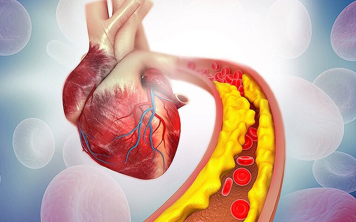 از کلسترول و تری گلیسرید بالا رنج می‌برید؟ این راهکار‌ها برای شماست