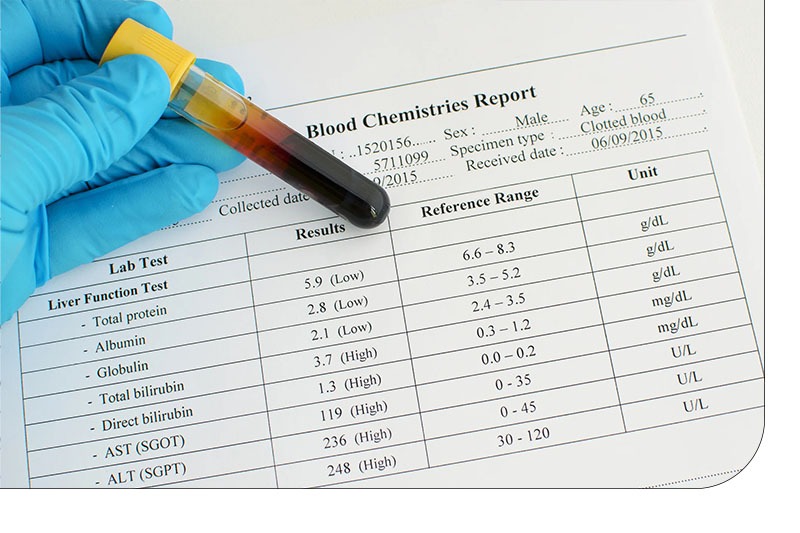 علت بالا بودن بیلی روبین توتال در بزرگسالان علت بالا بودن بیلی روبین توتال در بزرگسالان