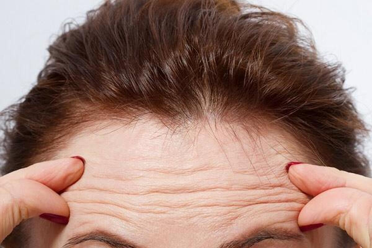 از بین بردن چروک پیشانی؛ معرفی بهترین و موثرترین روش