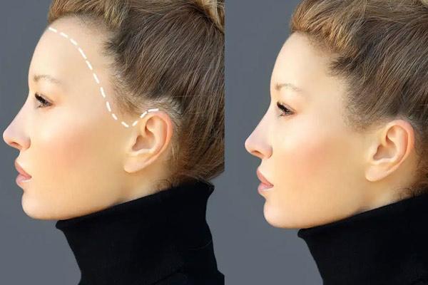 جراحی چین و چروک پیشانی جراحی چین و چروک پیشانی