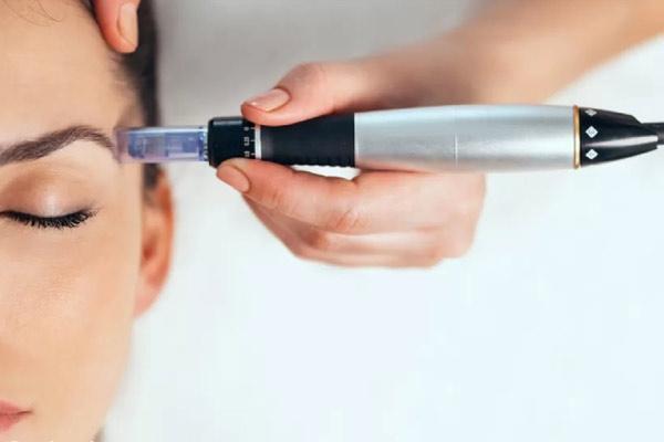 رفع چین و چروک پیشانی با میکرونیدلینگ و prp رفع چین و چروک پیشانی با میکرونیدلینگ و prp