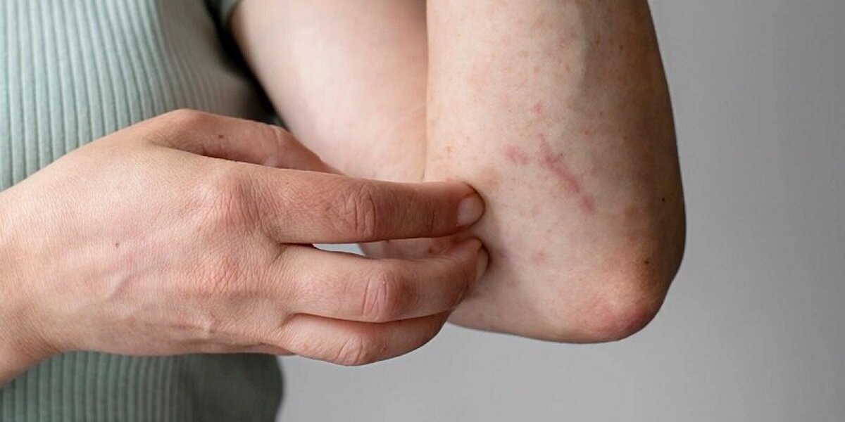 اگر این علائم در پوست شما ظاهر شد یعنی در حال ابتلا به دیابت هستید