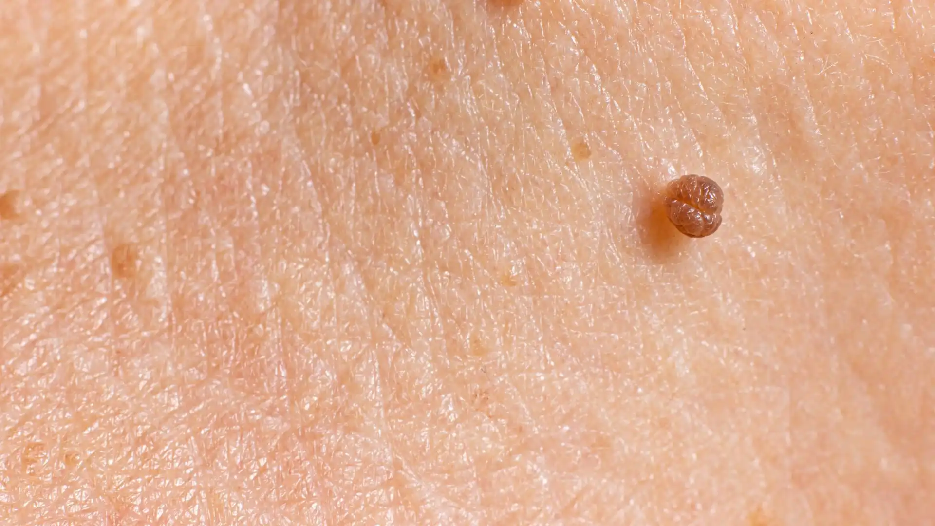 درمان فوری خال گوشتی درمان فوری خال گوشتی