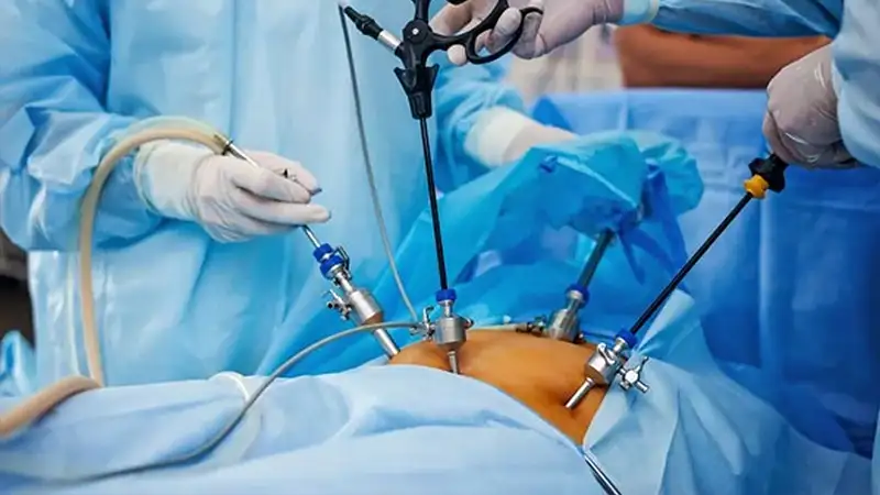 برای چاقی‌های درجه دو اسلیو معده بهتر است یا روش‌های غیرتهاجمی