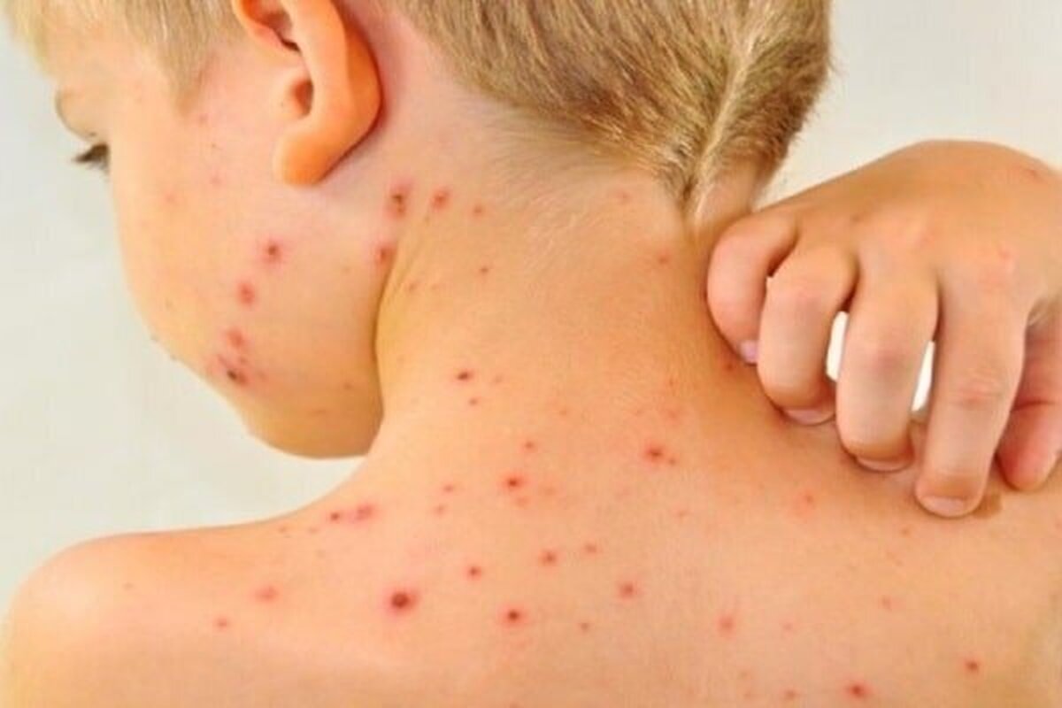 موارد ابتلا به سرخک در جهان افزایش یافت