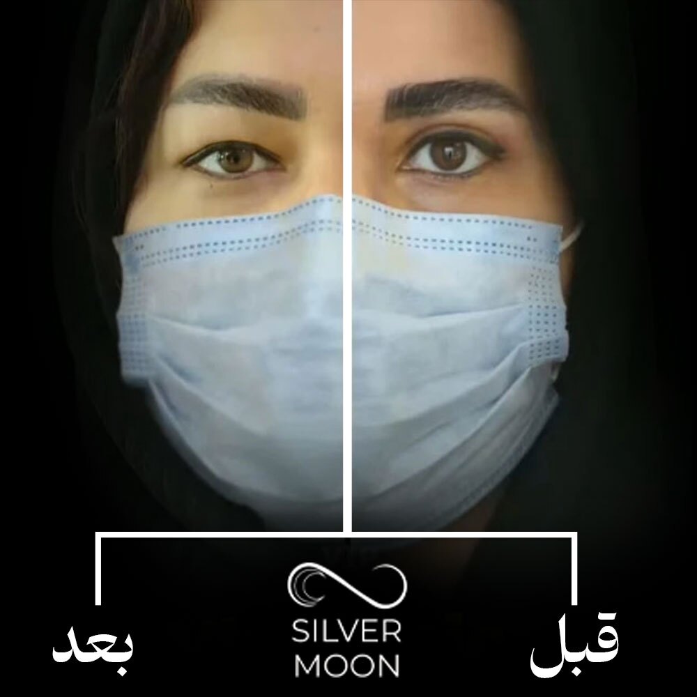 نمونه کار قبل و بعد بلفاروپلاستی در ماه نقره‌ای