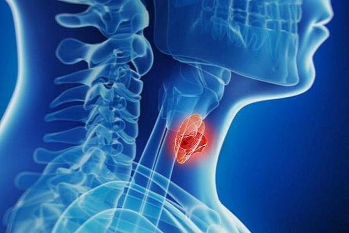 چگونه از ابتلا به انواع سرطان تیروئید پیشگیری کنیم؟